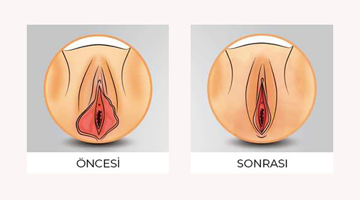 Labioplasti Sonrası