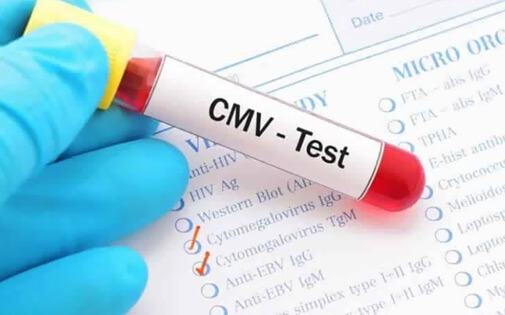 Anti Cmv İgg Testi Nedir? Nasıl Yapılır?